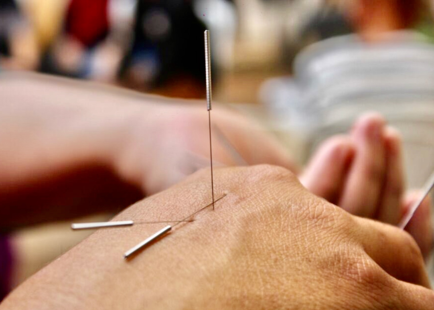 Akupunktur